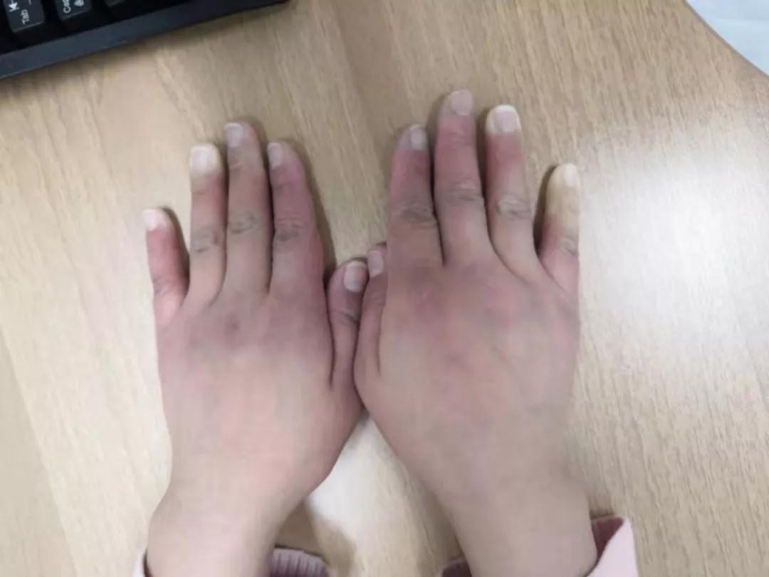 “手指、腳趾發(fā)白、發(fā)紫……”這些“小毛病”千萬(wàn)別大意