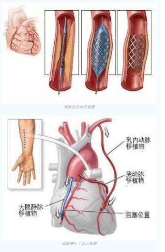 魚與熊掌不可兼得？冠脈雜交手術一站式解決問題