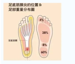 每年新生數(shù)百萬(wàn)足底筋膜炎患者！國(guó)際醫(yī)學(xué)專家提醒：跑步要選擇合適的鞋